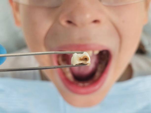 Best Emergency Dental Care for Broken or Chipped Teeth in Santa Ana Pueblo, NM